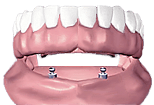 Illustration of an implant supported denture