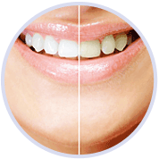 picture shows one side of smile with white teeth, the other with discolored teeth